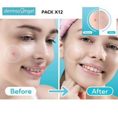 PARCHE ARNE PARCHE ACNE 12 UNIDADES PARCHES ACNE ACLARADORES MANCHAS ROJAS GRANOS