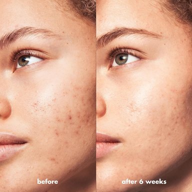 E.L.F. SKIN BLEMISH BREAKTHROUGH LIMPIADOR ACLARADOR DEL ACNÉ, LIMPIADOR FACIAL PARA COMBATIR IMPERFECCIONES - 4