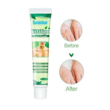Crema Natural Para Tratar Manchas de Vitiligo - 1