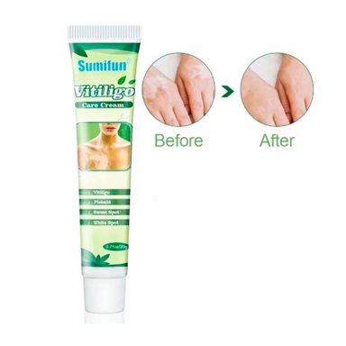 Crema Natural Para Tratar Manchas de Vitiligo - 2