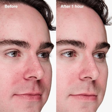 GEL ACLARADOR CLINIQUE ACNE SOLUTIONS™ CLINICAL ADVANCED - 2