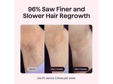 WAVYTALK DISPOSITIVO IPL BARE IT PARA CARA Y CUERPO SIN DOLOR, DOBLE PULSO DE 24J Y HIELO - 2