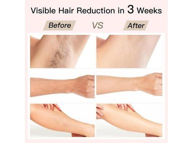 BOSIDIN DEPILACIÓN IPL CON ENFRIAMIENTO DE HIELO Y REJUVENECIMIENTO FACIAL, 6+1 MODOS, 6 NIVELES PARA TODA LA FAMILIA - 2