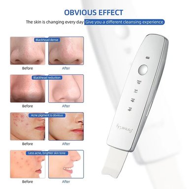 PALETA ULTRASÓNICA LIMPIEZA FACIAL PROFUNDA EMS TERAPIA LED - 6